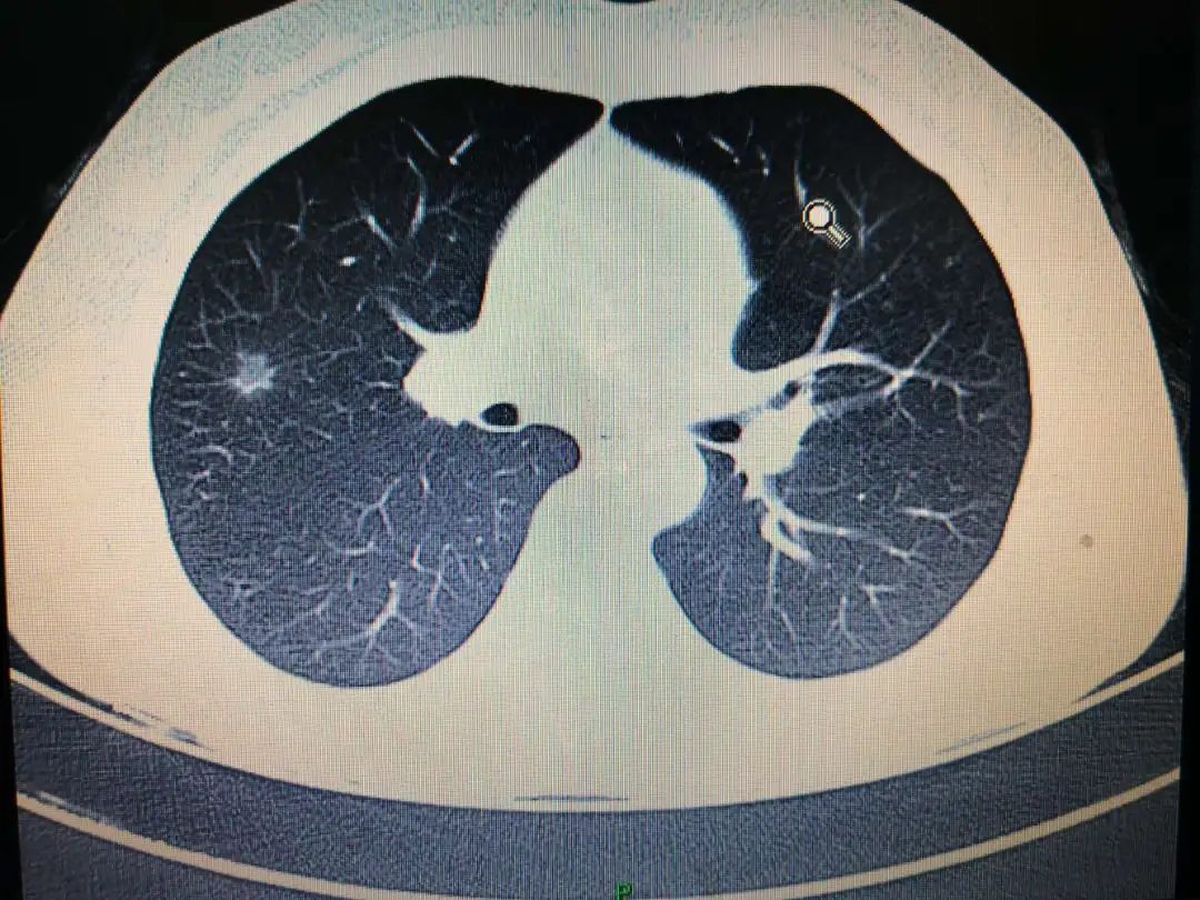 为什么CT很多人有肺部小结节，肺部小结节可能是什么原因