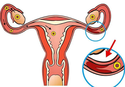 输卵管堵塞有什么样症状