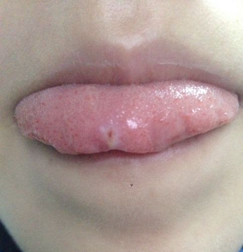 舌头上溃疡怎么治？舌头溃疡的几种疗法