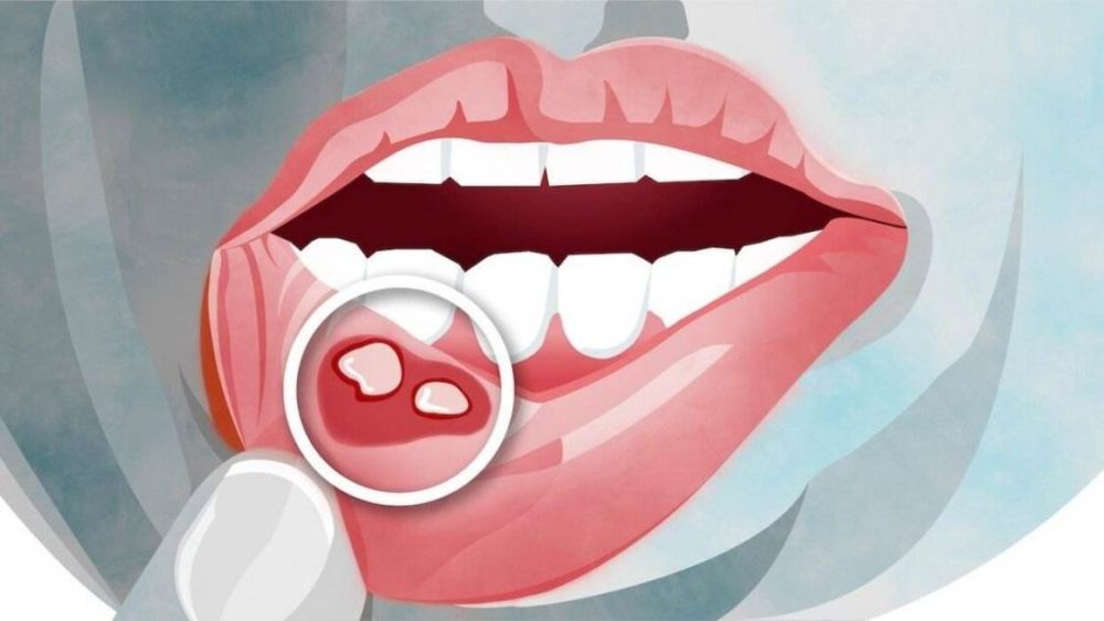 口腔溃疡怎么办最快最有效的方法