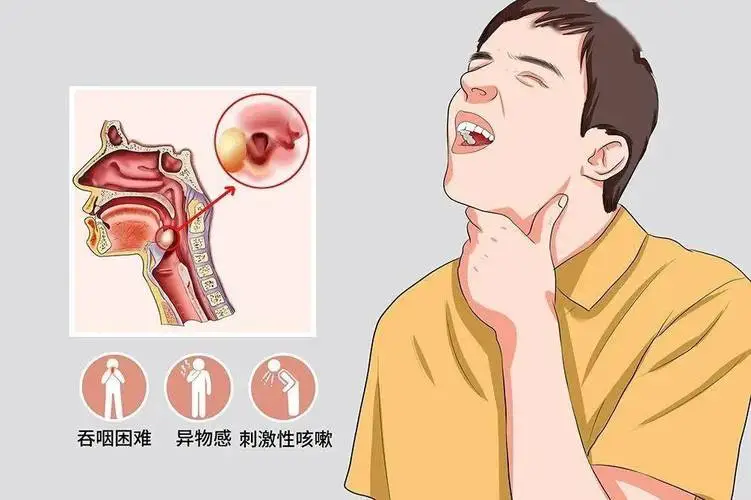 喉咙有异物感吞咽有堵塞感，是有痰吗