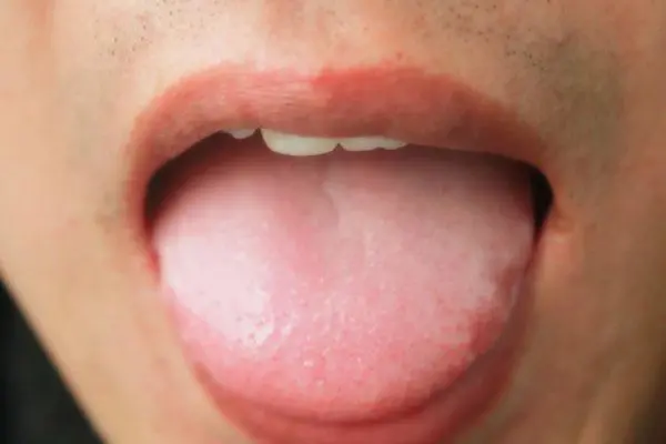 舌头白苔厚是什么原因，到底身体出现了什么问题