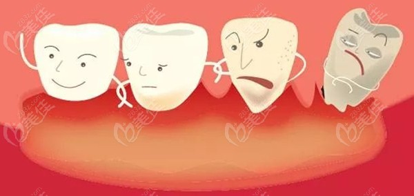 牙周炎的症状，牙周炎的表现