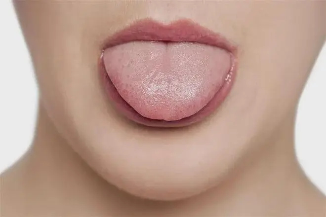 舌头上有裂纹是什么原因？揭秘舌头上的裂纹原因