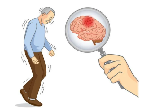 脑梗的症状都有哪些前期症状，想了解下脑梗前期都有哪些症状呢