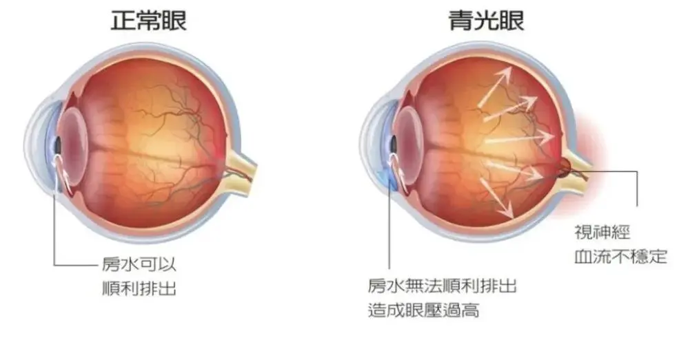 青光眼的症状和表现是什么？青光眼该怎么办？