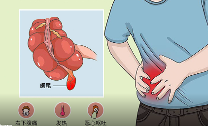 阑尾炎是哪个部位疼，阑尾炎疼痛是发生在左边还是右边