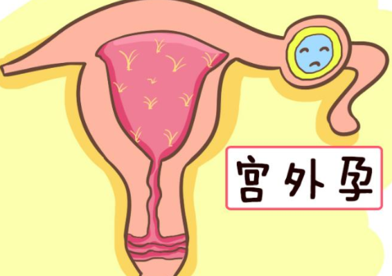 宫外孕的症状有哪些表现