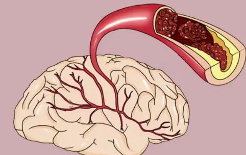 脑供血不足症状表现有哪些？所谓脑供血不足，指的是由于脑部某一部位或者多个部位供血不足而引起脑功能障碍。脑供血不足会引发非常多的症状，也会引发非常多的潜在危险，我们就从多方面来讲讲脑部供血不足有哪些原因。