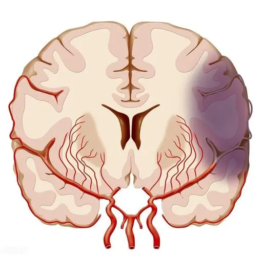 脑供血不足症状表现有哪些，有哪三种症状