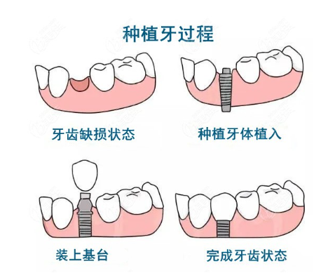 种植牙的过程步骤，普通人种牙的具体流程
