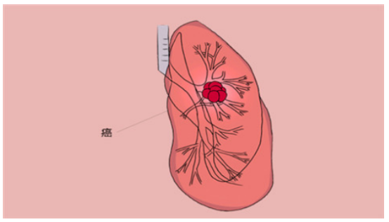 肺癌的早期症状和前兆，感染上肺癌的早期症状有哪些