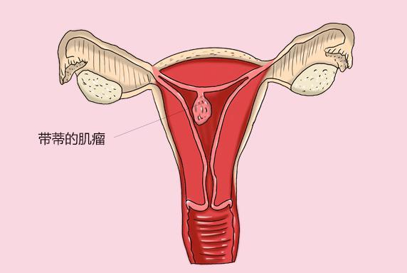 子宫肌瘤是什么原因导致的，子宫肌瘤应该如何治疗
