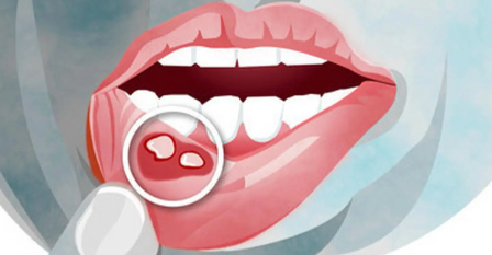 口腔溃疡怎么办最快最有效的方法?教你一个简单的方法，快速治好口腔溃疡
